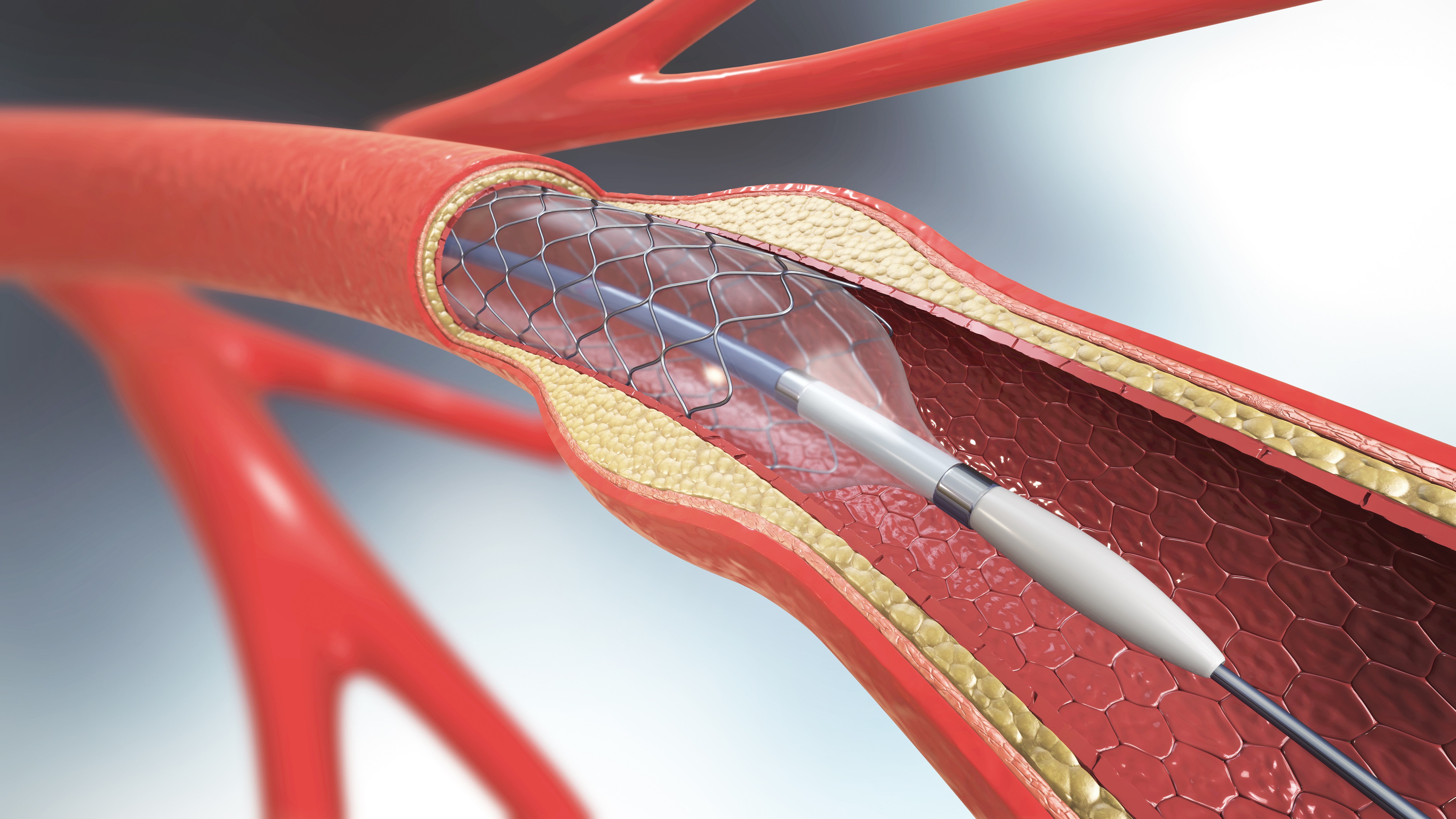 Stent Nedir? Nasıl Takılır? | Koroner Balon ve Stent