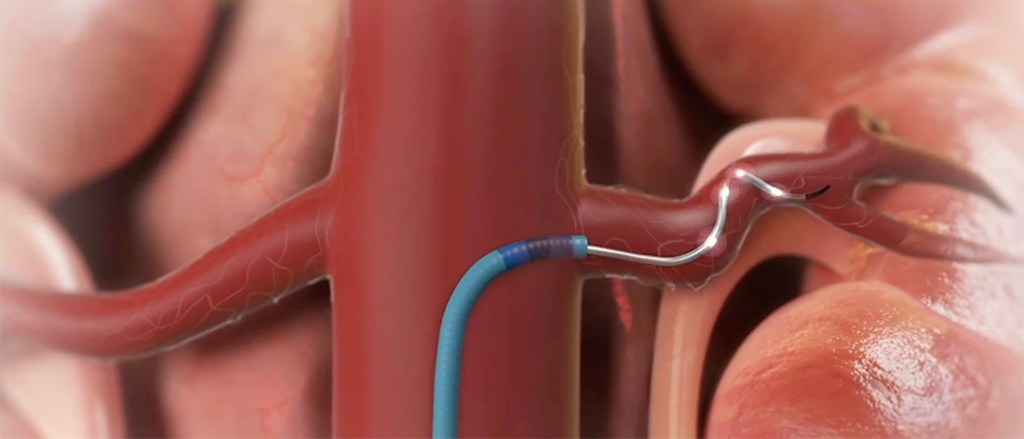 Renal Denervasyon Nedir? Kimlere Uygulanır? | Dirençli Hipertansiyon